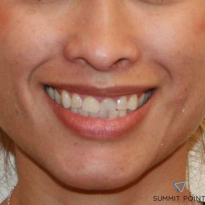 Before veneers